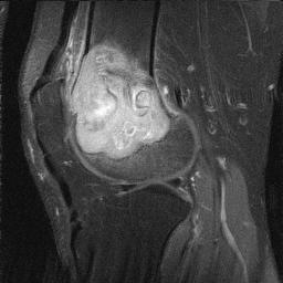 GCT Distal Femur MRI0002